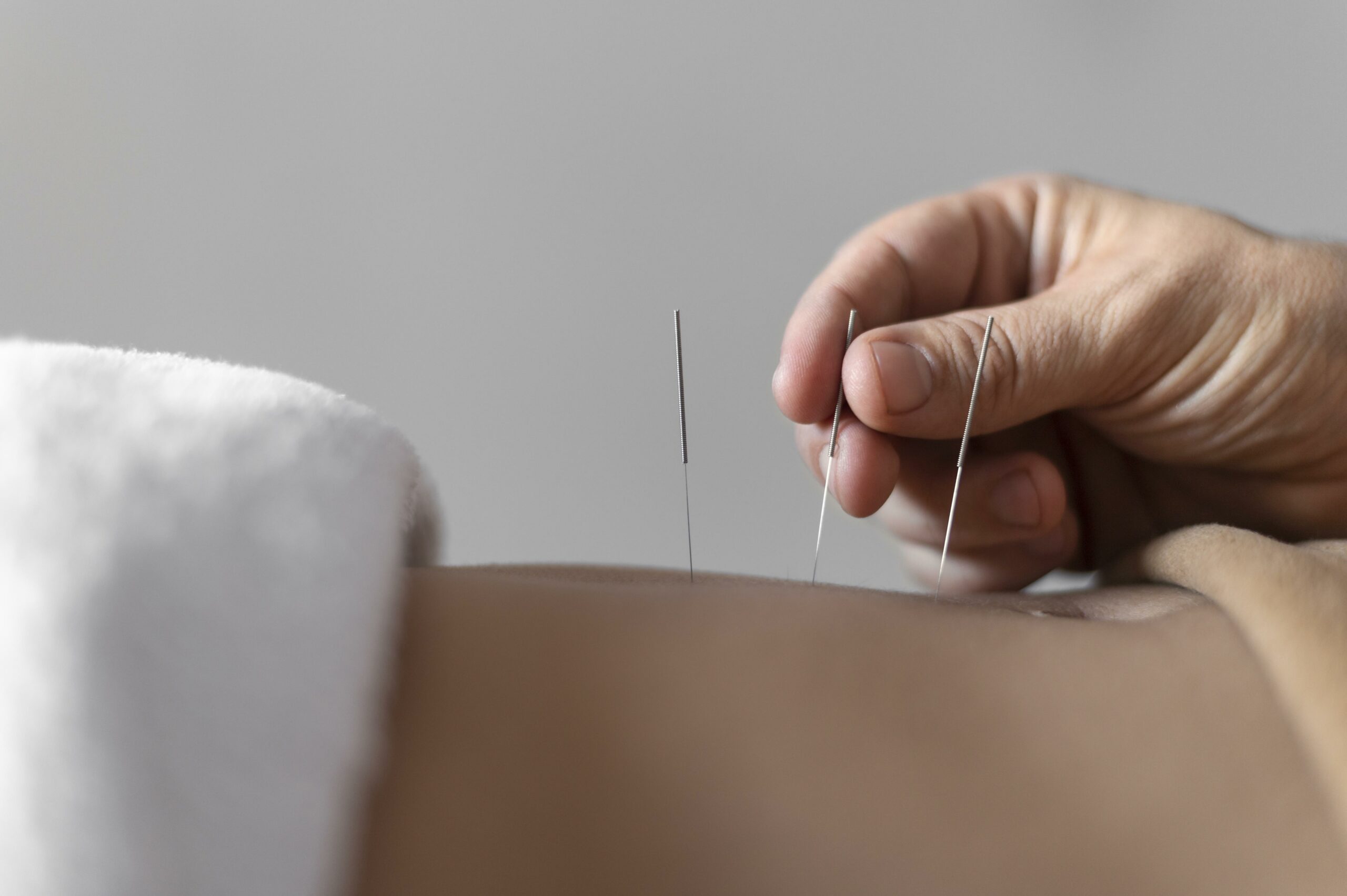 HOW TO USE ACUPUNCTURE FOR PIRIFORMIS SYNDROME PAIN RELIEF