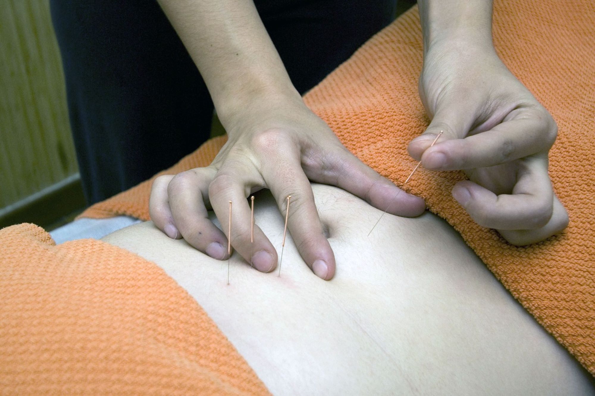 Acupuncture Without Borders Training