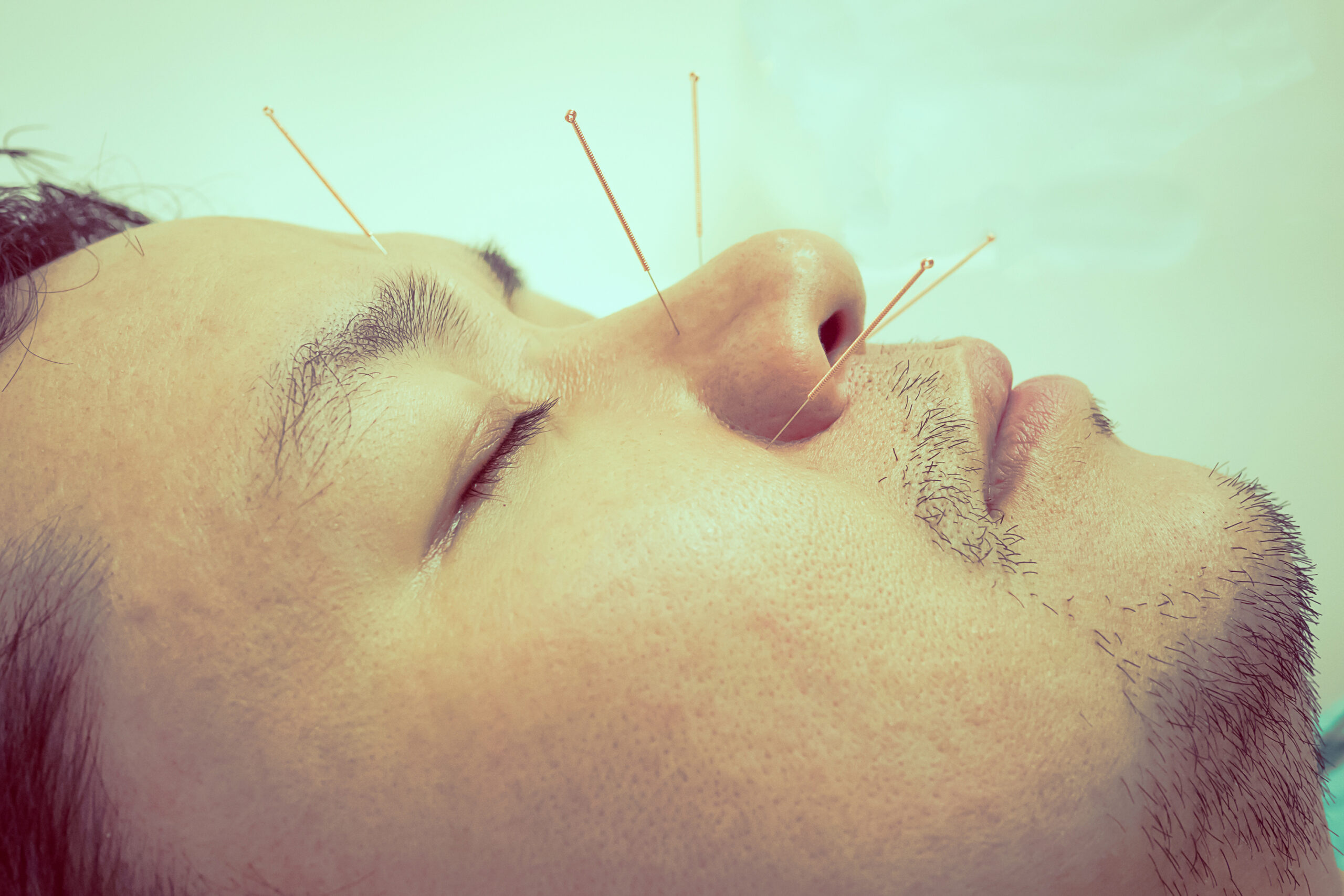 THE BENEFITS OF ACUPUNCTURE FOR ANXIETY AND DEPRESSION: A CLINICAL TRIAL