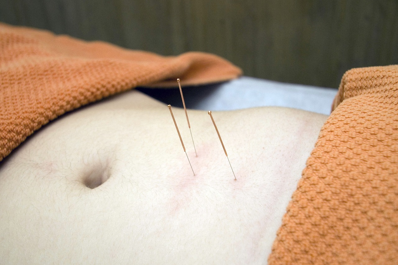 THE BENEFITS OF ACUPUNCTURE FOR STRESS MANAGEMENT