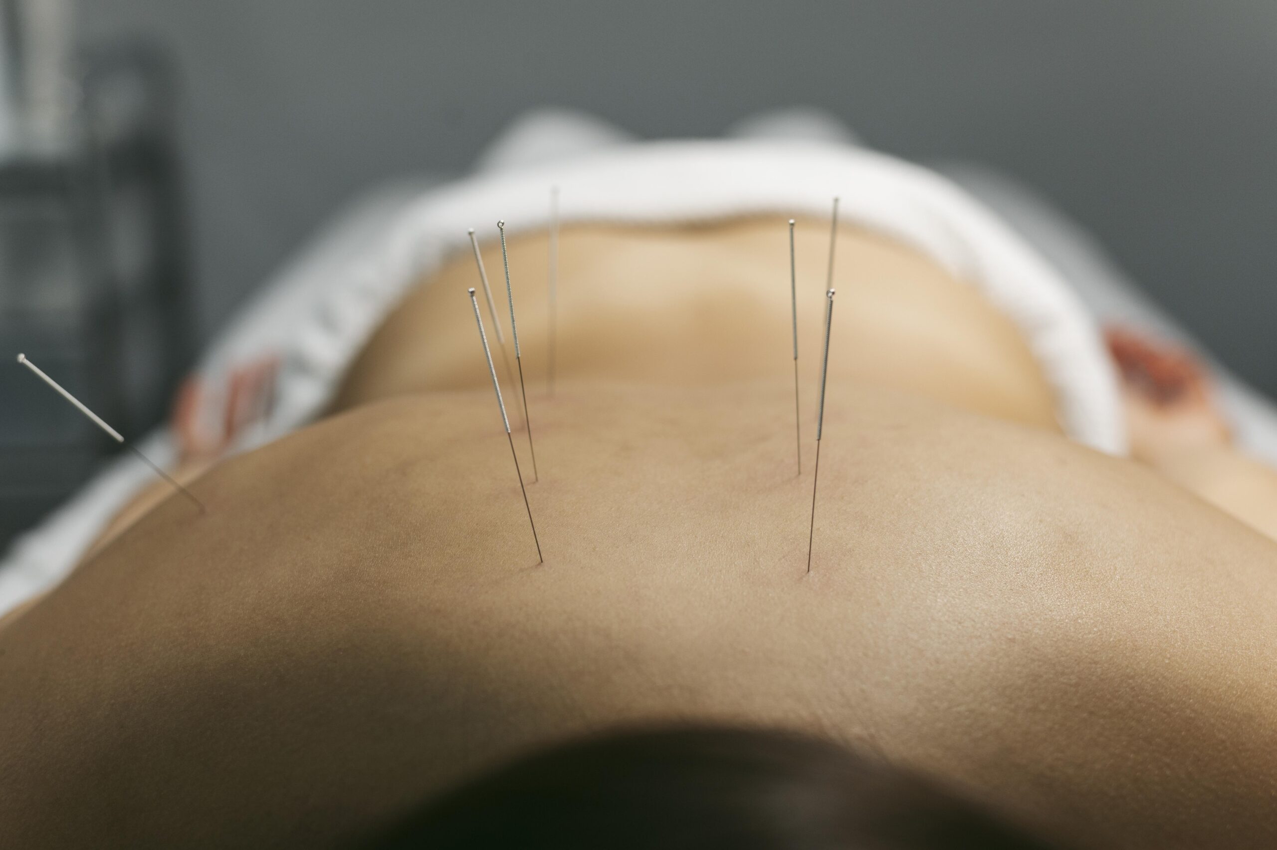USING ACUPUNCTURE FOR CHRONIC LOWER BACK PAIN MANAGEMENT
