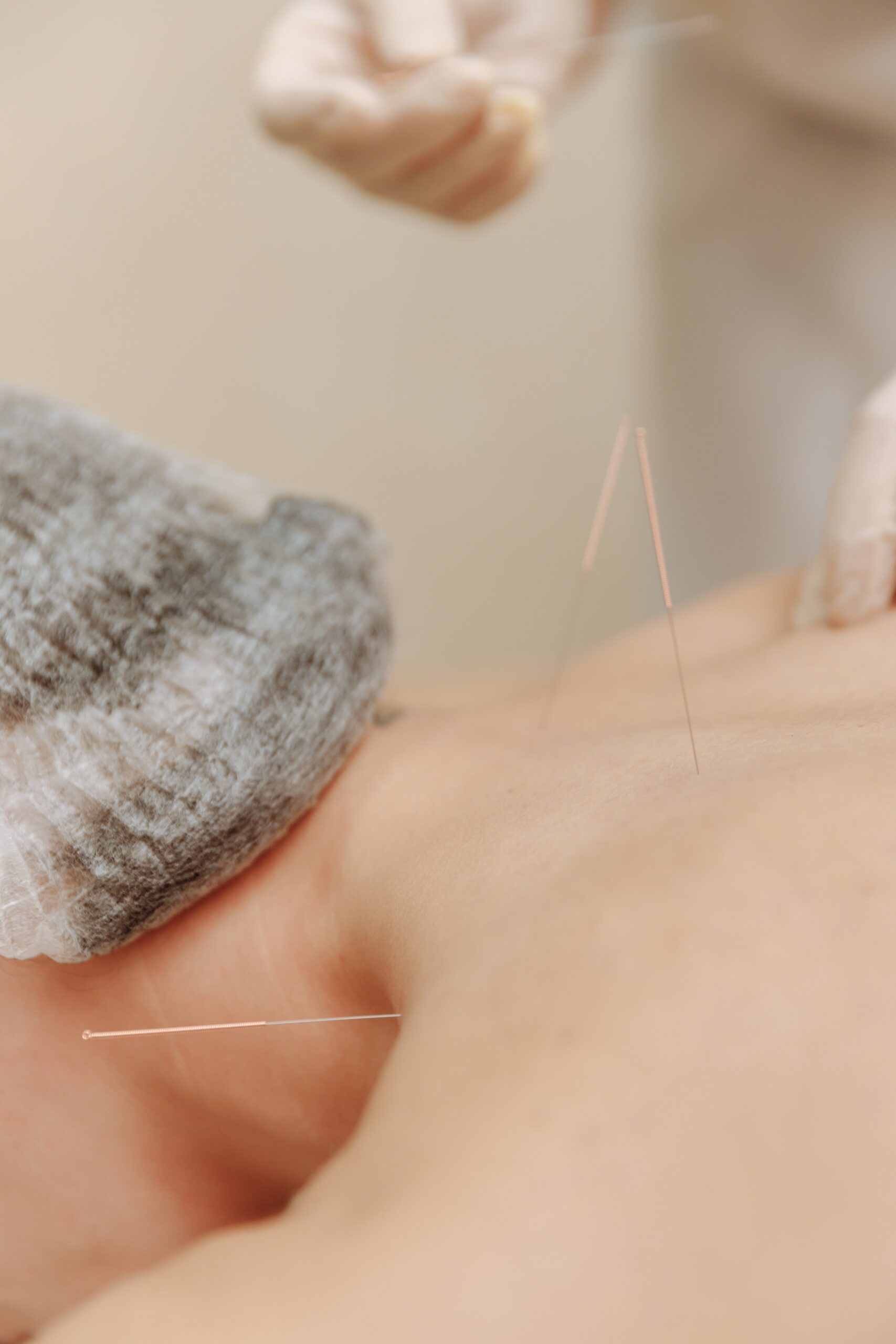 HOW TO USE ACUPUNCTURE FOR MENISCUS TEAR PAIN RELIEF